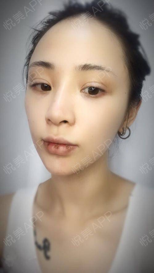 人中缩短术术后3天_玻尿酸丰唇术后3天_丰唇/唇珠术后3天_人中缩短术