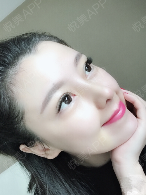 【成都水晶唯罗纳鼻综合隆鼻案例术后】今天已经可以美美的上妆了,我