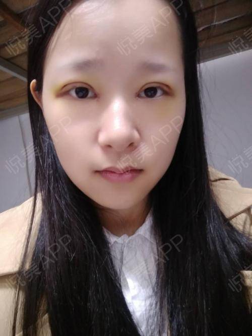 长沙美莱双眼皮#我是11号做的手术,当天人很多,可能.开眼角_悦美整形