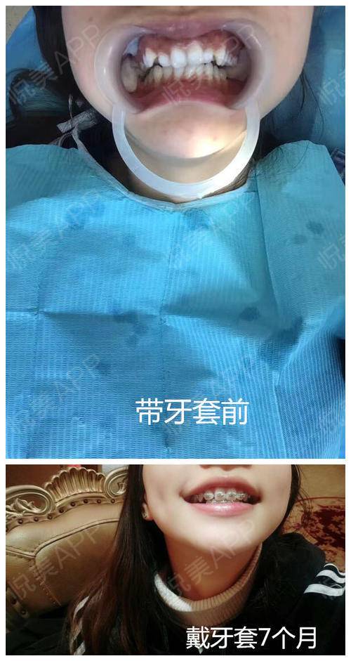 牙齿矫正术后230天_牙齿美容术后230天_琪大大大大分享图片1