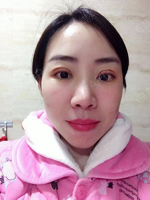 上海百达丽邵玉芳医生做的双眼皮手术,手术后7天,这.