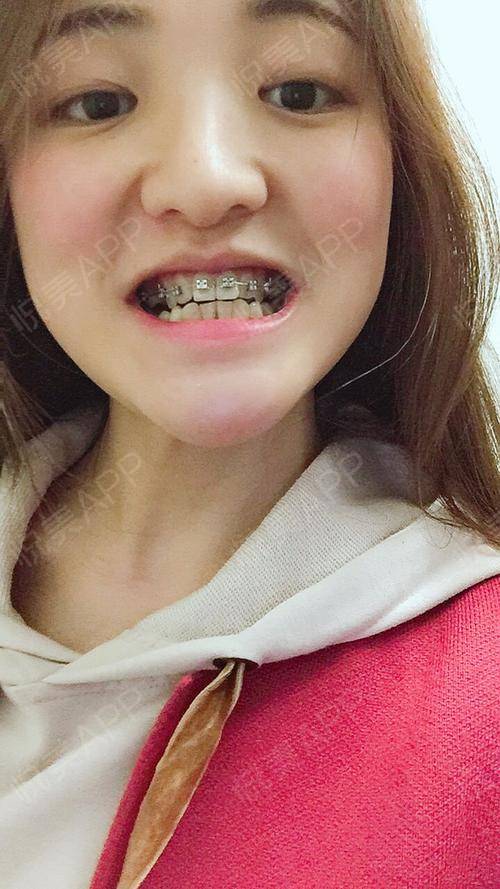 牙齿矫正术后18天_牙齿美容术后18天_jp贾分享图片4