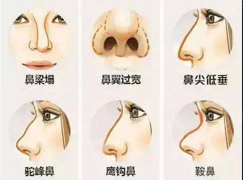 鼻尖,鼻翼,鼻孔,鼻小柱等 采用不同的方法 比如鼻背隆高,鼻尖形状调整
