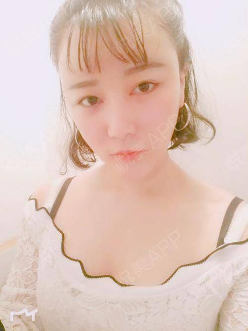 自体脂肪隆胸术后34天_其他填充术后34天_隆胸术后34天_自体脂肪术后