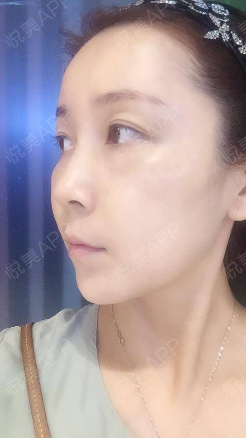 瘦脸针术后26天_肉毒素术后26天_去鱼尾纹术后26天_瘦脸术后26天_除皱