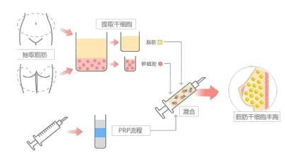 原来,自体脂肪丰胸是这样的!