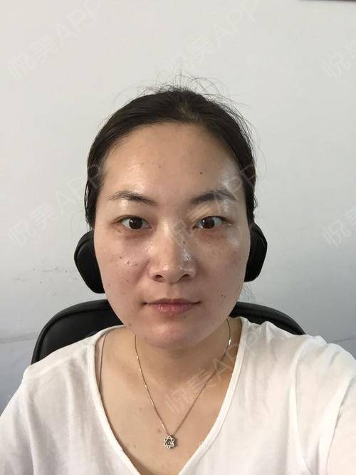 眼袋的话恢复起来真的比其他项目手术的快本来内切去眼袋创伤就比较小