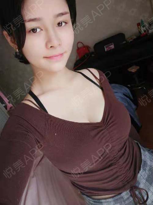 复合隆胸术后70天_乳房下垂矫正术后70天_自体脂肪隆胸术后70天_假体