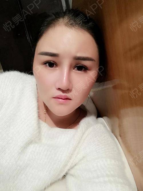 鼻综合整形术后15天_鼻综合术后15天_鼻部术后15天_悦mer_4800895453