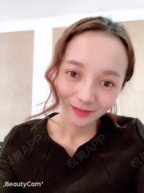 硅胶假体隆鼻术后220天_鼻综合术后220天_隆鼻术后220天_鼻部术后220