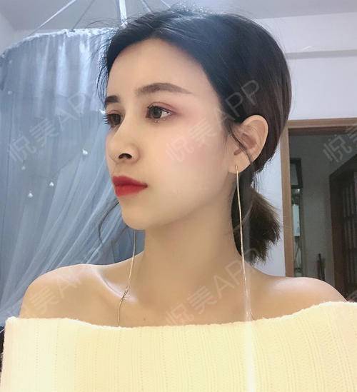 术后54天_自体脂肪术后54天_面部轮廓术后54天_小耳朵minmin分享图片5