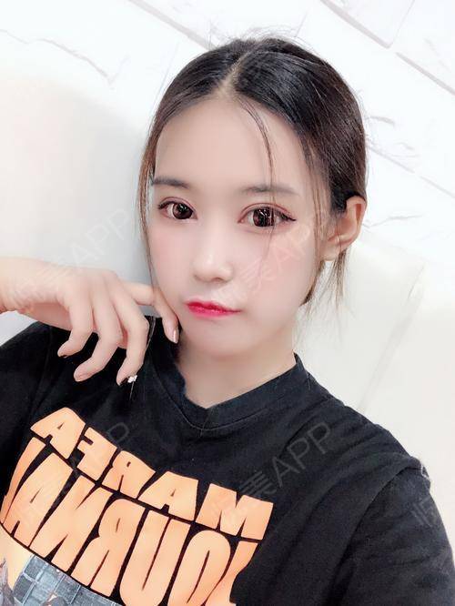 鼻综合整形术后13天_鼻综合术后13天_鼻部术后13天_悦mer_3368087531