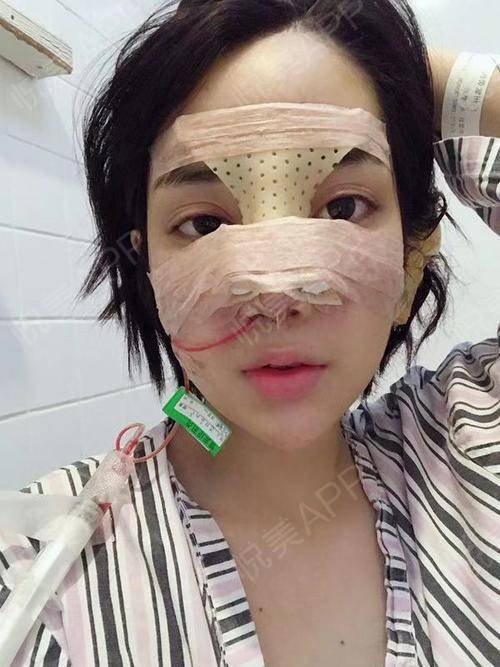哈喽,今天是我在广州紫馨做完鼻综合手术的第一天哦,.