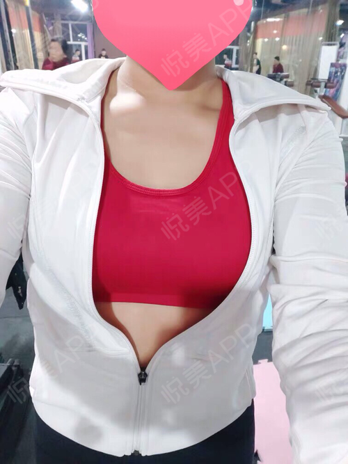 乳房下垂矫正术后543天_巨乳缩小术后543天_胸型美化术后543天_隆胸术