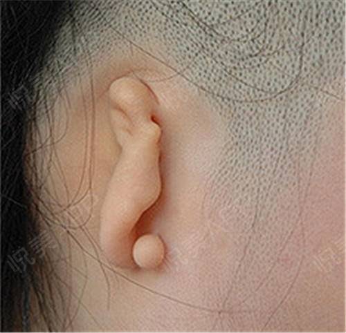 小( 耳) 甲腔型:有较小的耳甲腔,有耳屏,耳垂,外耳整体"缩小一大圈".