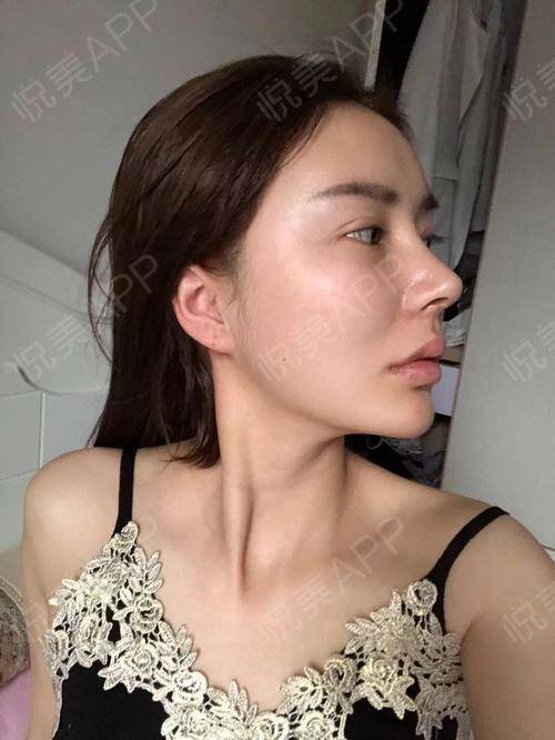 鼻综合整形术后21天_自体肋软骨隆鼻术后21天_手术延长鼻小柱术后21天