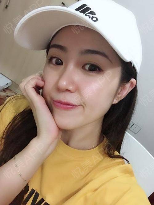 鼻综合整形术后35天_鼻综合术后35天_鼻部术后35天_莹莹呀莹莹分享