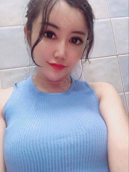 假体隆胸术后34天_鼻综合术后34天_隆胸术后34天_胸部整形术后34天